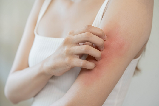 8 Ways to Treat Common Skin Rashes